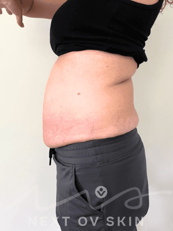 Before body sculpting treatment showing abdomen and flank fullness