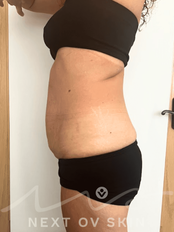 After body sculpting treatment showing improved contour and reduced fullness