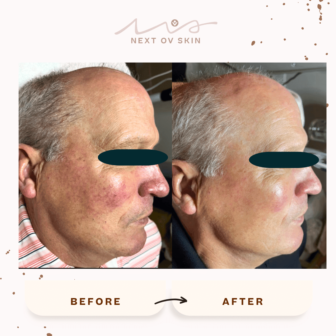 Rosacea treatment results after multiple laser genesis sessions