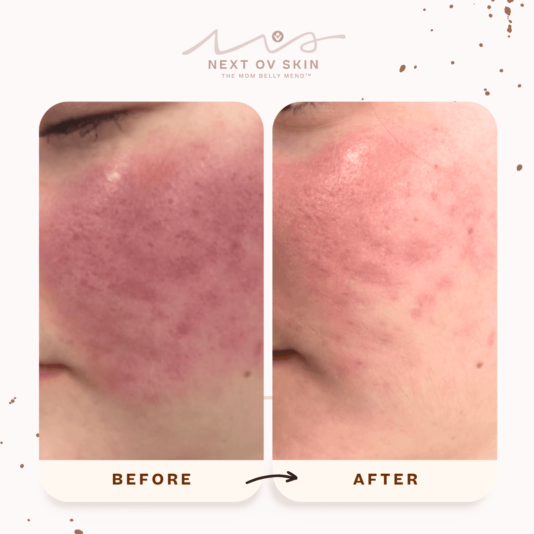 Active acne treatment before and after showing cleared breakouts