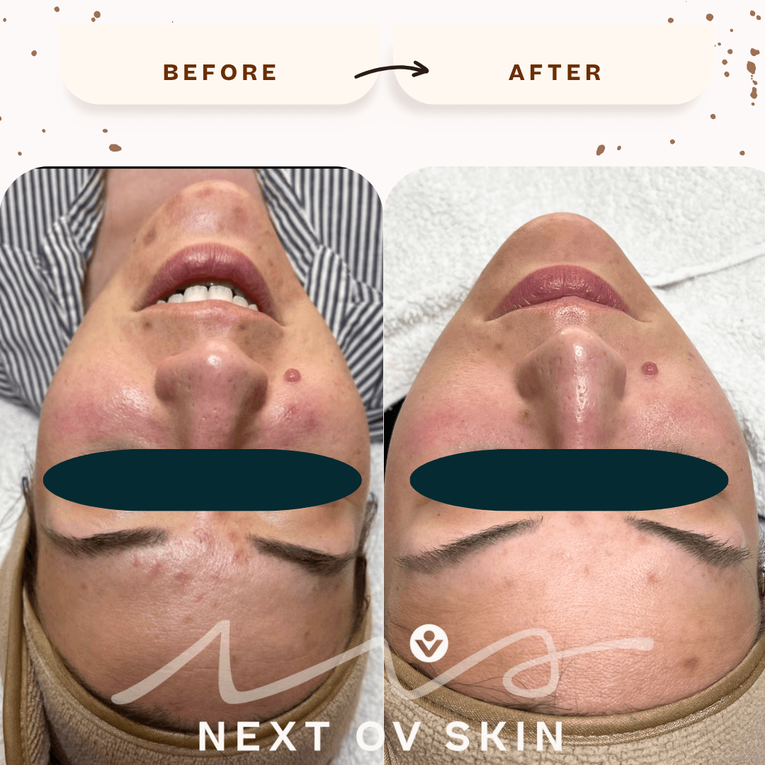Teen acne clearing results after laser facial treatment