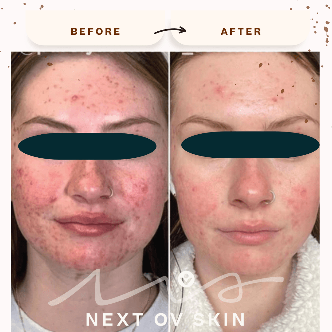 Acne scarring improvement before and after RF microneedling