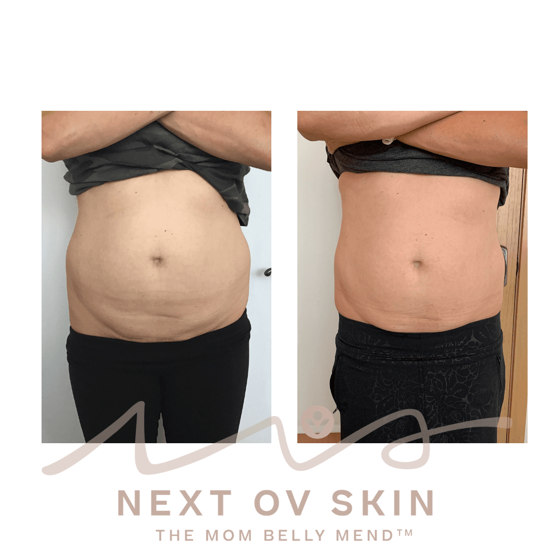 Stomach fat reduction before and after non-surgical treatment