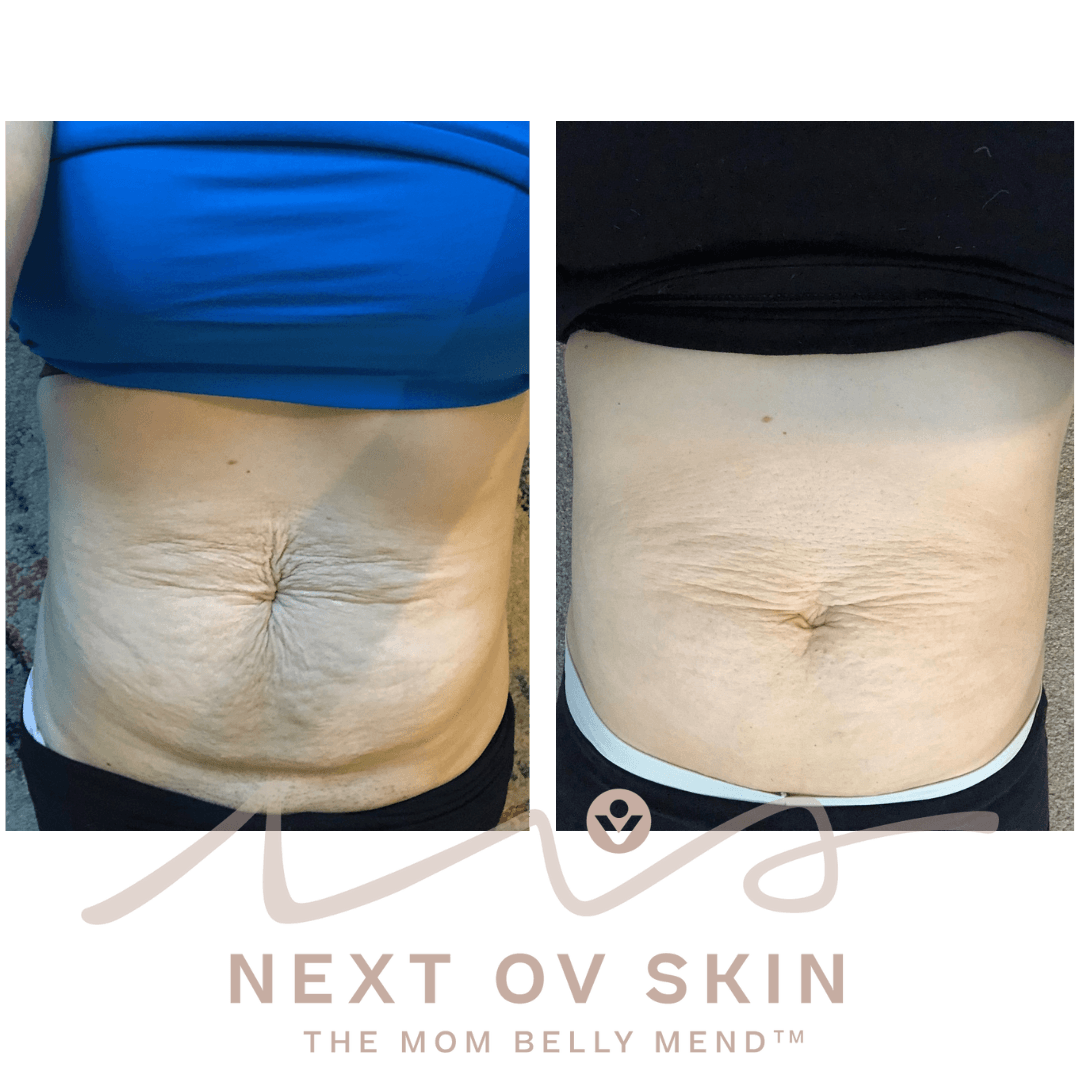 Post-pregnancy belly tightening before and after treatment