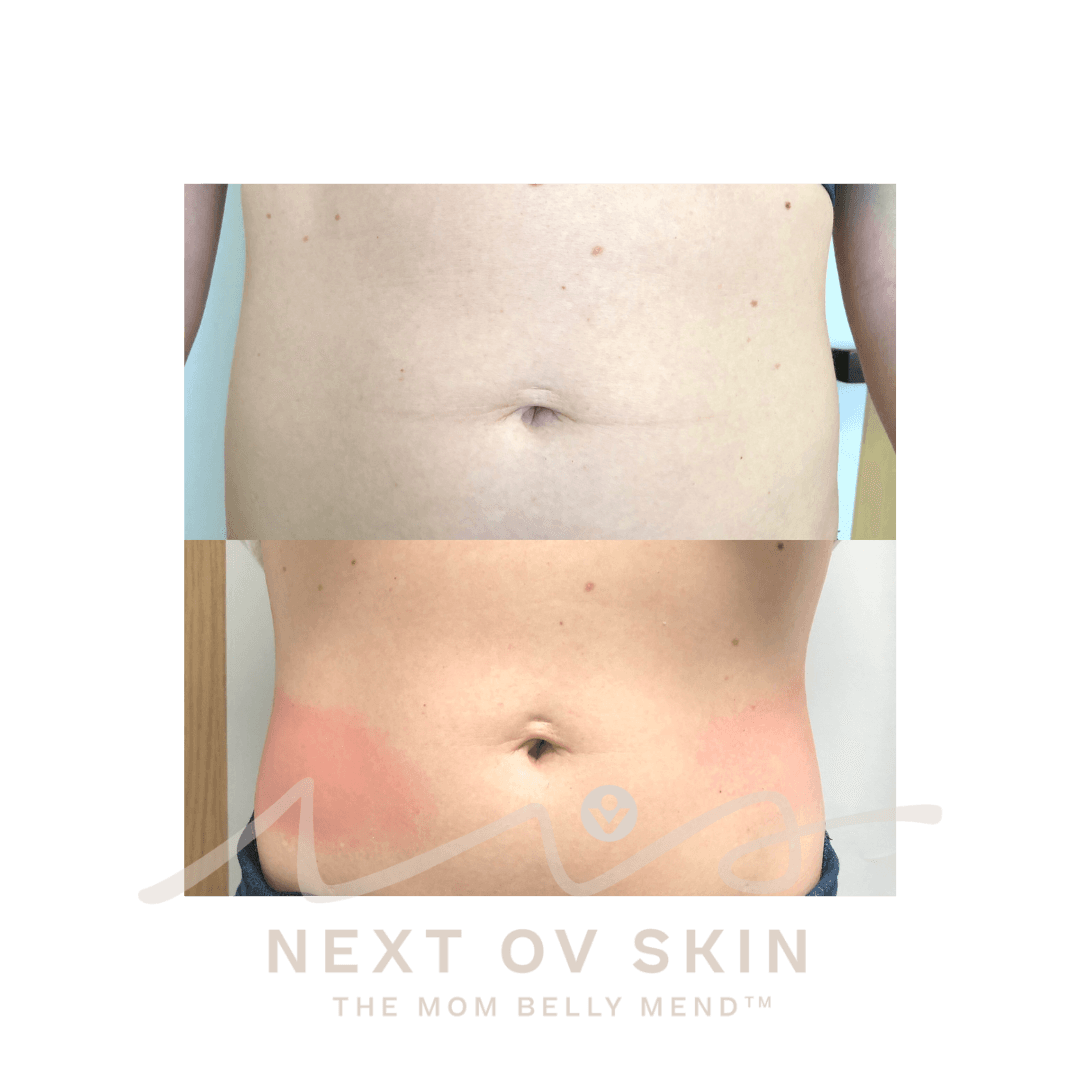 Waist sculpting before and after body contouring treatment