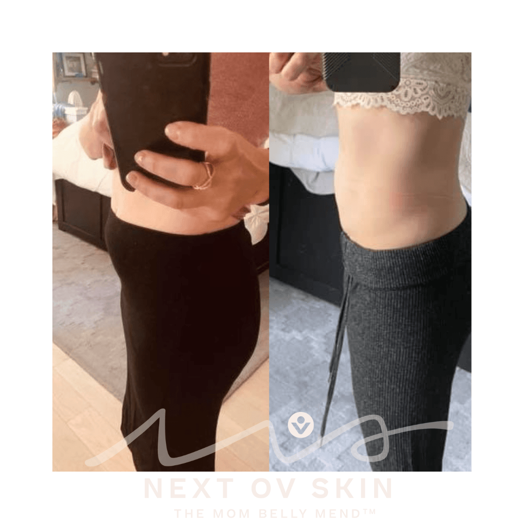 MomBellyMend postpartum stomach recovery results