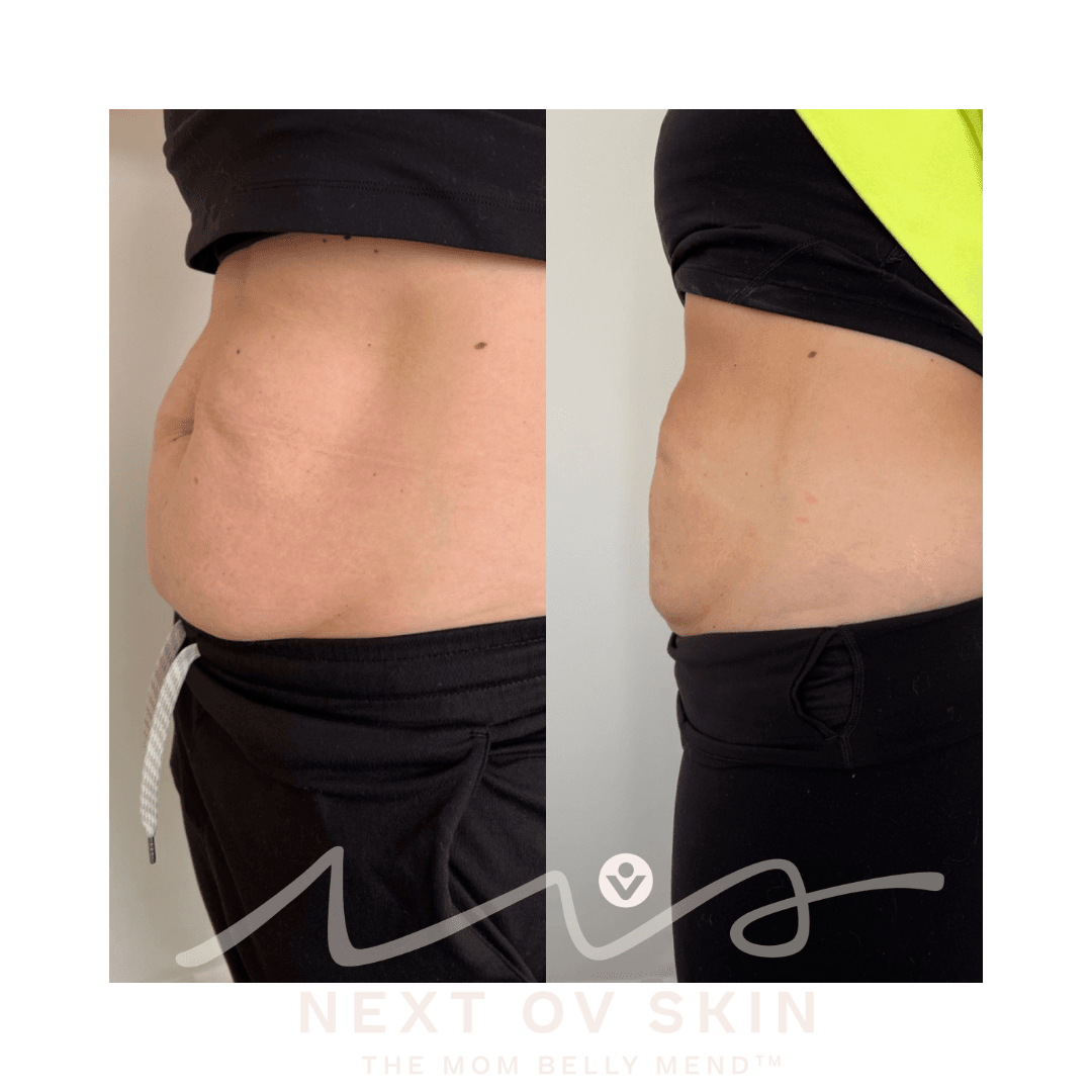 Non-surgical tummy tuck before and after HIFU treatment