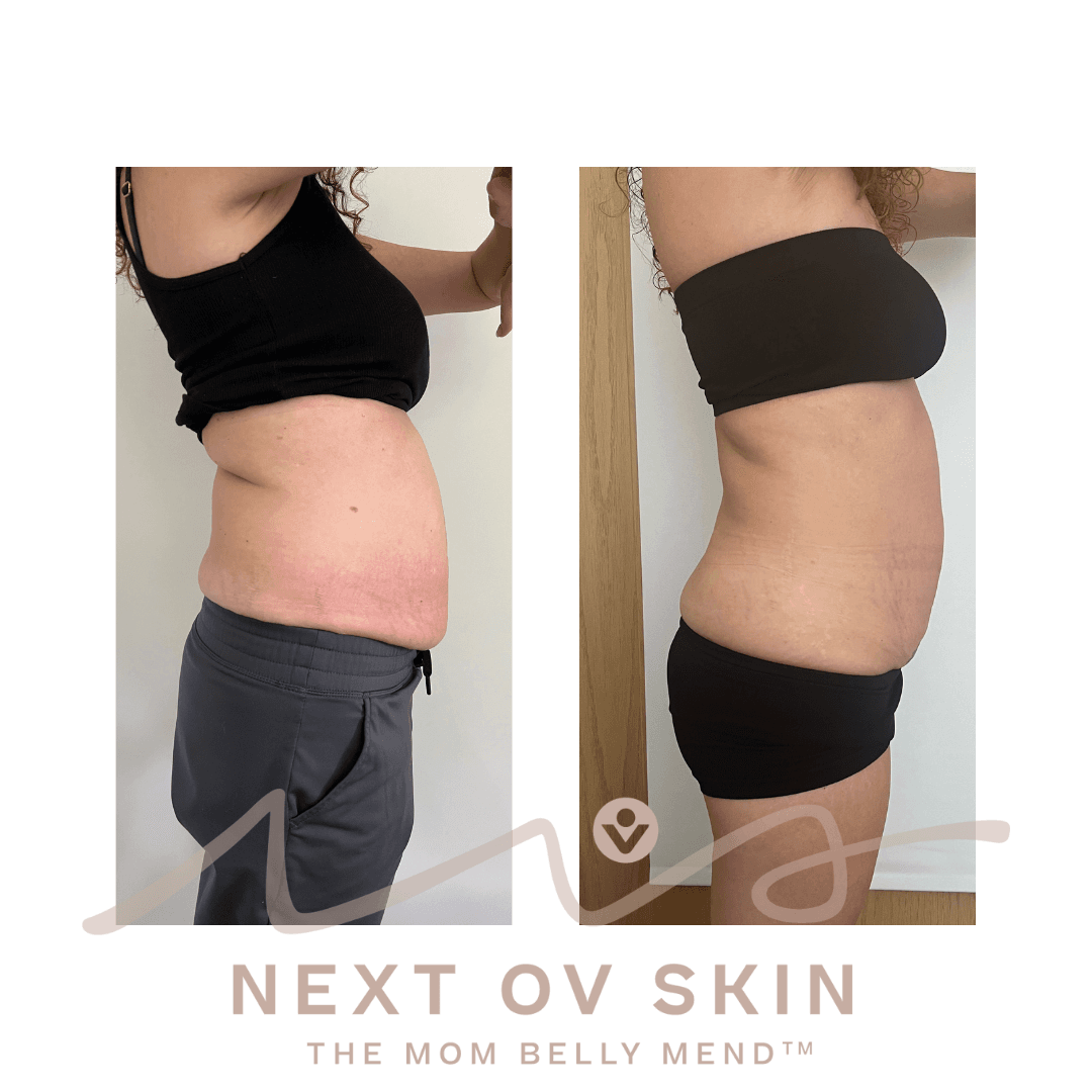 Non-surgical mommy makeover before and after full body transformation