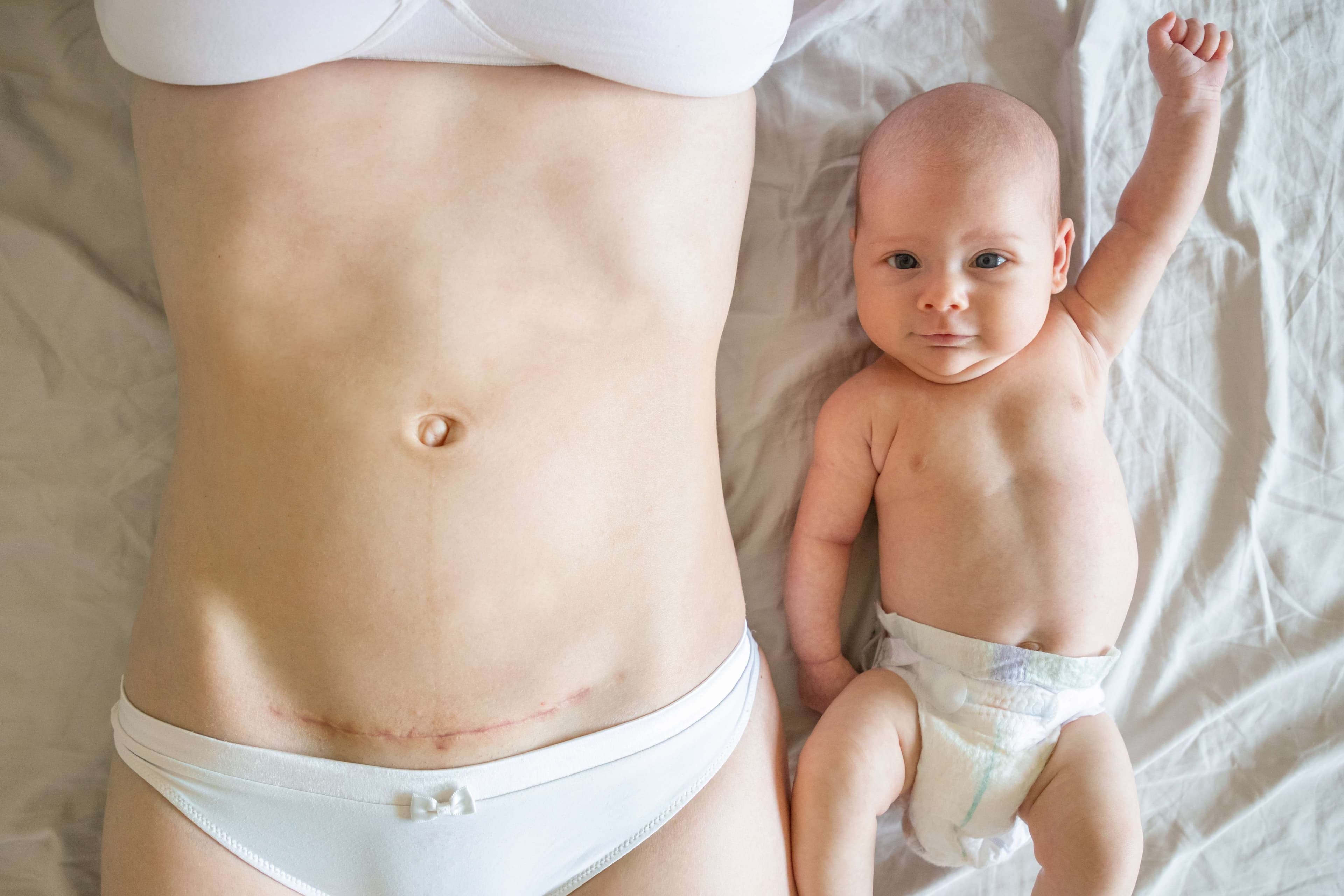 Close-up of c-section scar with baby resting on mother
