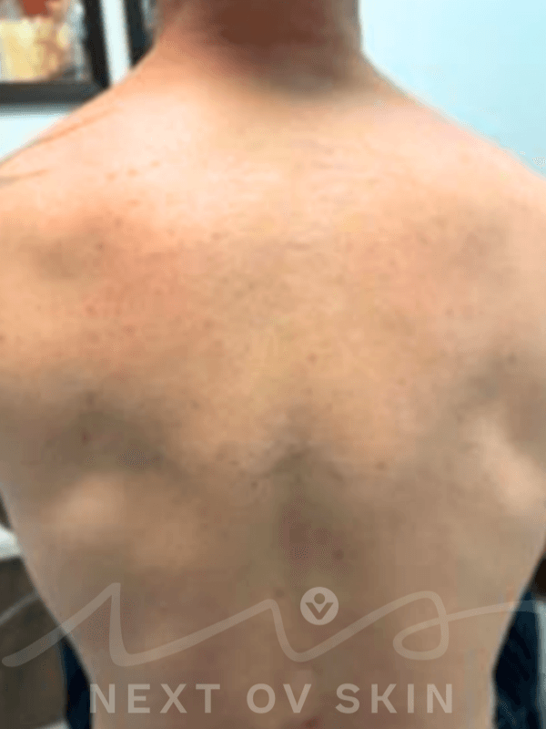 Back tattoo significantly faded after laser treatments