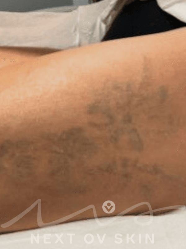 Significantly faded tattoo after laser removal treatments