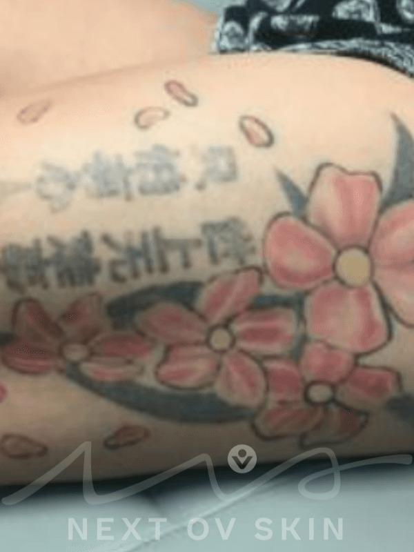 Colorful tattoo with cherry blossoms before laser removal