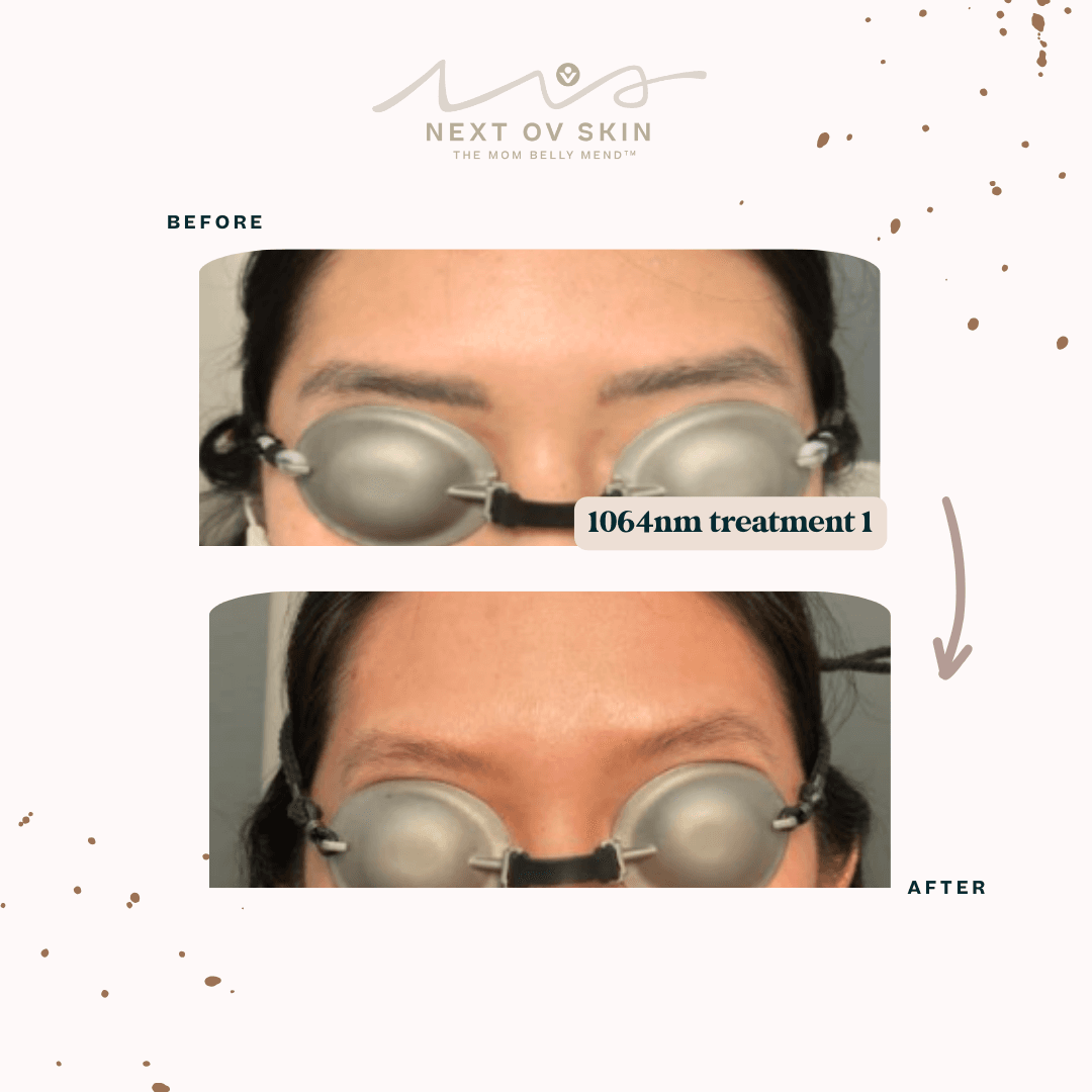 Microblading removal before and after - 1064nm laser treatment showing significant brow pigment fading after one session