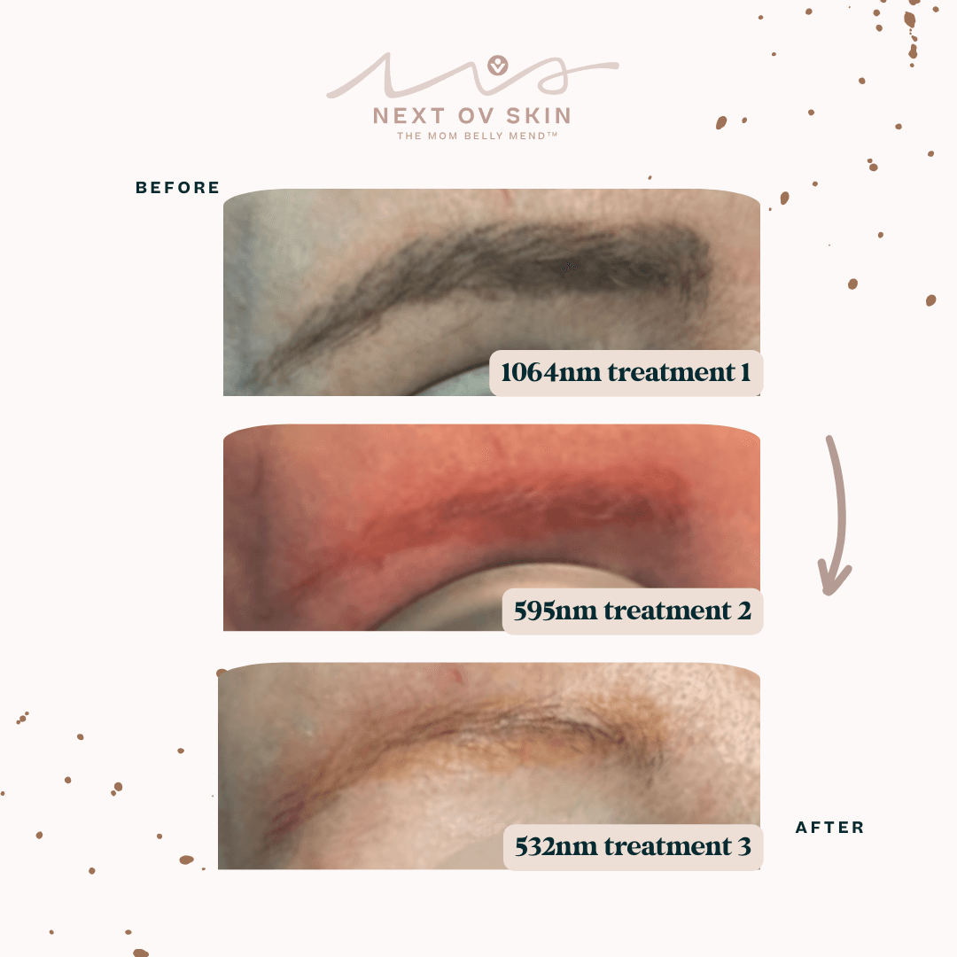 Microblading removal progression showing 3 sessions - 1064nm, 595nm, and 532nm wavelength treatments clearing different pigment colors