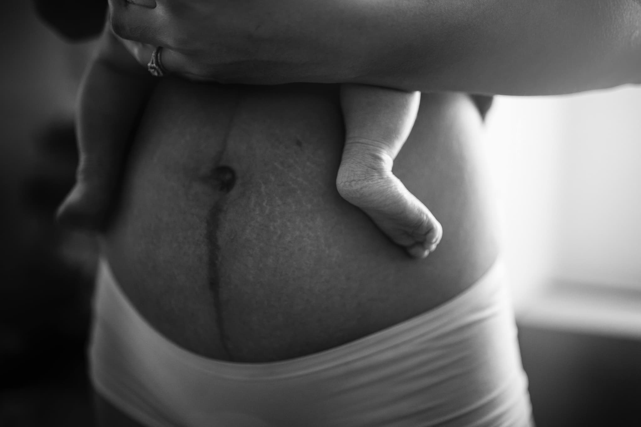 Postpartum belly with baby foot - understanding c-section scar healing